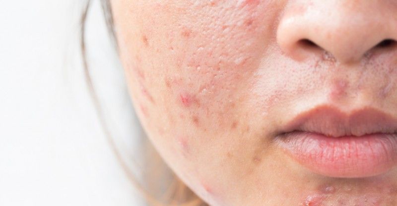 Quy trình 5 bước chăm sóc da sau nặn mụn bạn nên biết