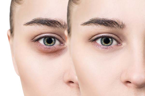 16 Cách trị mắt thâm tại nhà nhanh và hiệu quả nhất trong 1 tuần